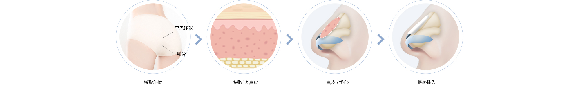 採取部位 > 採取した真皮 > 真皮デザイン > 最終挿入