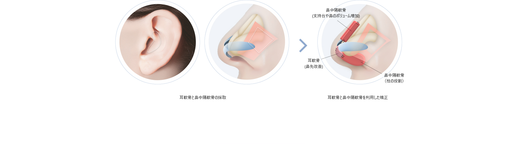 耳軟骨と鼻中隔軟骨の採取 > 耳軟骨と鼻中隔軟骨を利用した矯正