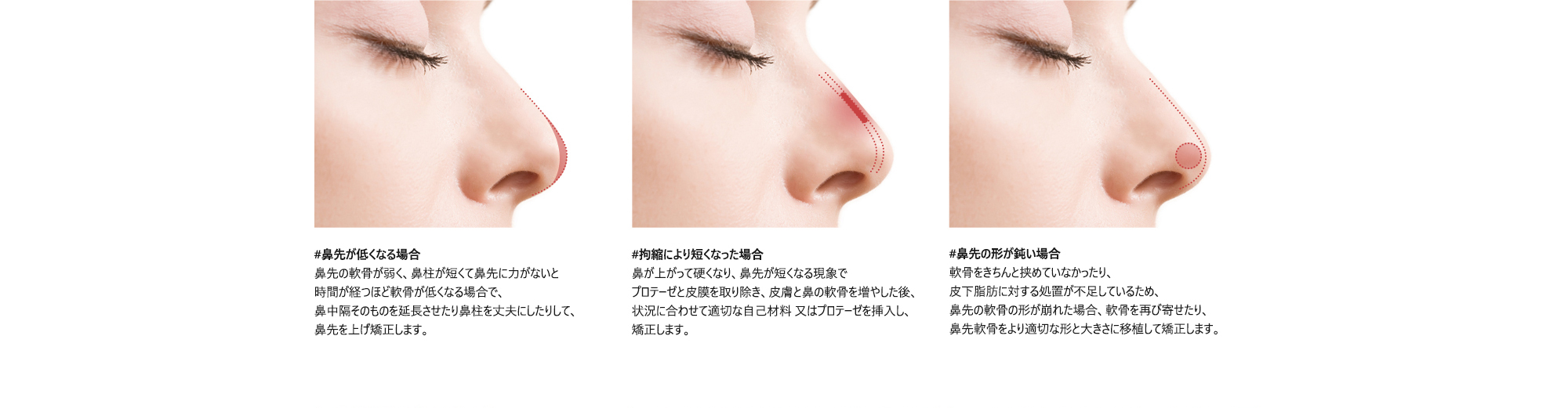 #鼻先が低くなる場合 : 鼻先の軟骨が弱く、鼻柱が短くて鼻先に力がないと時間が経つほど軟骨が低くなる場合で、鼻中隔そのものを延長させたり鼻柱を丈夫にしたりして、鼻先を上げ矯正します。/ #拘縮により短くなった場合 : 鼻が上がって硬くなり、鼻先が短くなる現象でプロテーゼと皮膜を取り除き、皮膚と鼻の軟骨を増やした後、状況に合わせて適切な自己材料 又はプロテーゼを挿入し、矯正します。