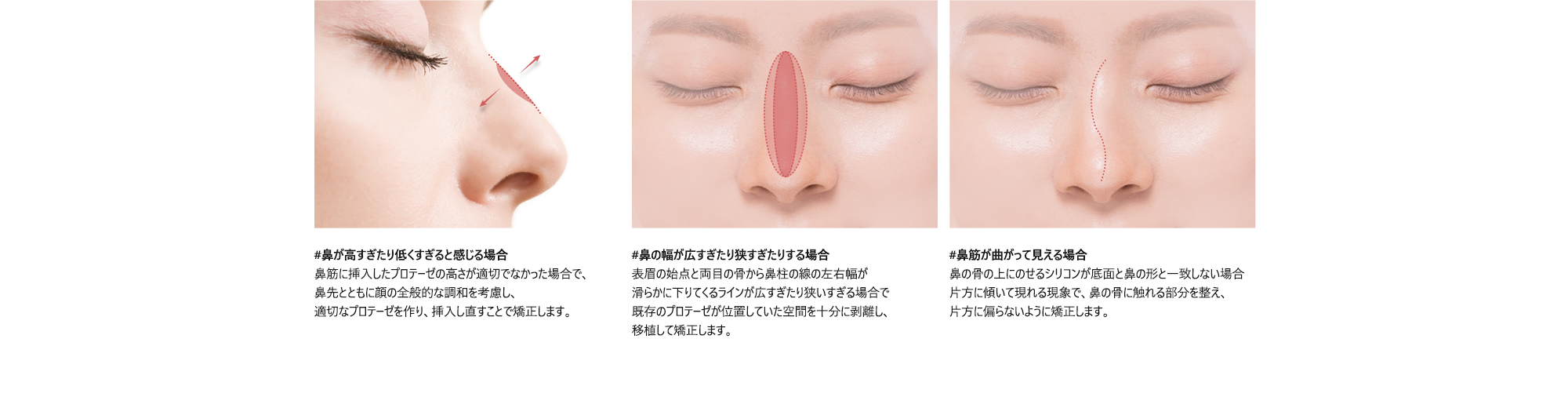 #鼻が高すぎたり低くすぎると感じる場合 : 鼻筋に挿入したプロテーゼの高さが適切でなかった場合で、鼻先とともに顔の全般的な調和を考慮し、適切なプロテーゼを作り、挿入し直すことで矯正します。/ #鼻の幅が広すぎたり狭すぎたりする場合 : 表眉の始点と両目の骨から鼻柱の線の左右幅が滑らかに下りてくるラインが広すぎたり狭いすぎる場合で既存のプロテーゼが位置していた空間を十分に剥離し、移植して矯正します。/ #鼻筋が曲がって見える場合 : 鼻の骨の上にのせるシリコンが底面と鼻の形と一致しない場合片方に傾いて現れる現象で、鼻の骨に触れる部分を整え、片方に偏らないように矯正します。