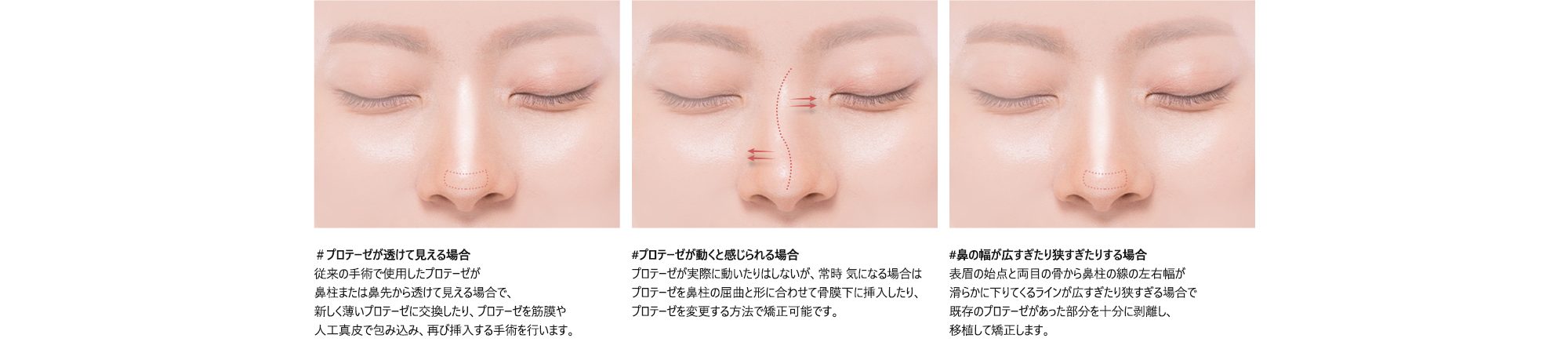 ＃プロテーゼが透けて見える場合 : 従来の手術で使用したプロテーゼが鼻柱または鼻先から透けて見える場合で、新しく薄いプロテーゼに交換したり、プロテーゼを筋膜や人工真皮で包み込み、再び挿入する手術を行います。/ #プロテーゼが動くと感じられる場合 : プロテーゼが実際に動いたりはしないが、常時 気になる場合はプロテーゼを鼻柱の屈曲と形に合わせて骨膜下に挿入したり、プロテーゼを変更する方法で矯正可能です。/ #鼻の幅が広すぎたり狭すぎたりする場合 : 表眉の始点と両目の骨から鼻柱の線の左右幅が滑らかに下りてくるラインが広すぎたり狭すぎる場合で既存のプロテーゼがあった部分を十分に剥離し、移植して矯正します。