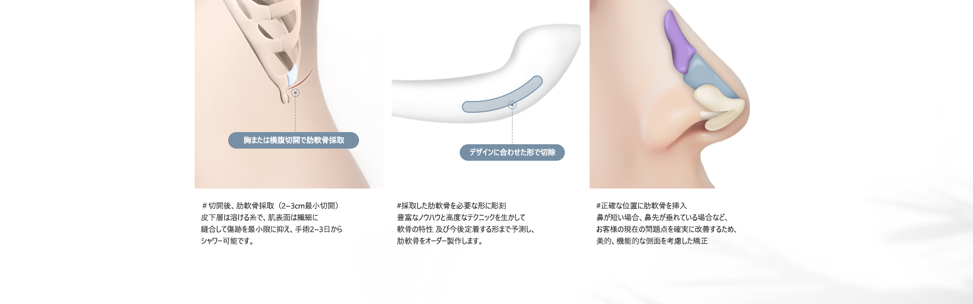＃切開後、肋軟骨採取（2~3cm最小切開）: 皮下層は溶ける糸で、肌表面は繊細に縫合して傷跡を最小限に抑え、手術2~3日からシャワー可能です。  #採取した肋軟骨を必要な形に彫刻 : 豊富なノウハウと高度なテクニックを生かして軟骨の特性 及び今後定着する形まで予測し、肋軟骨をオーダー製作します。  #正確な位置に肋軟骨を挿入 : 鼻が短い場合、鼻先が垂れている場合など、お客様の現在の問題点を確実に改善するため、美的、機能的な側面を考慮した矯正