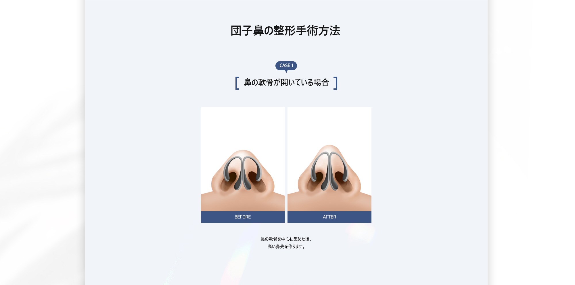 [団子鼻の整形手術方法] CASE 1. 鼻の軟骨が開いている場合 : 鼻の軟骨を中心に集めた後、高い鼻先を作ります。