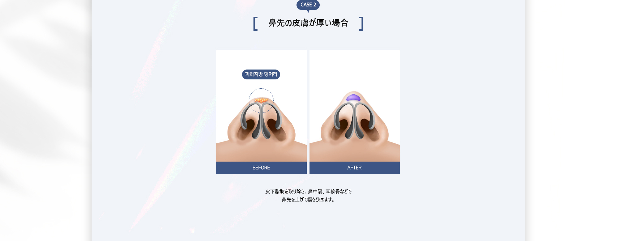 CASE 2. 鼻の軟骨を中心に集めた後、高い鼻先を作ります。 : 鼻の軟骨を中心に集めた後、高い鼻先を作ります。