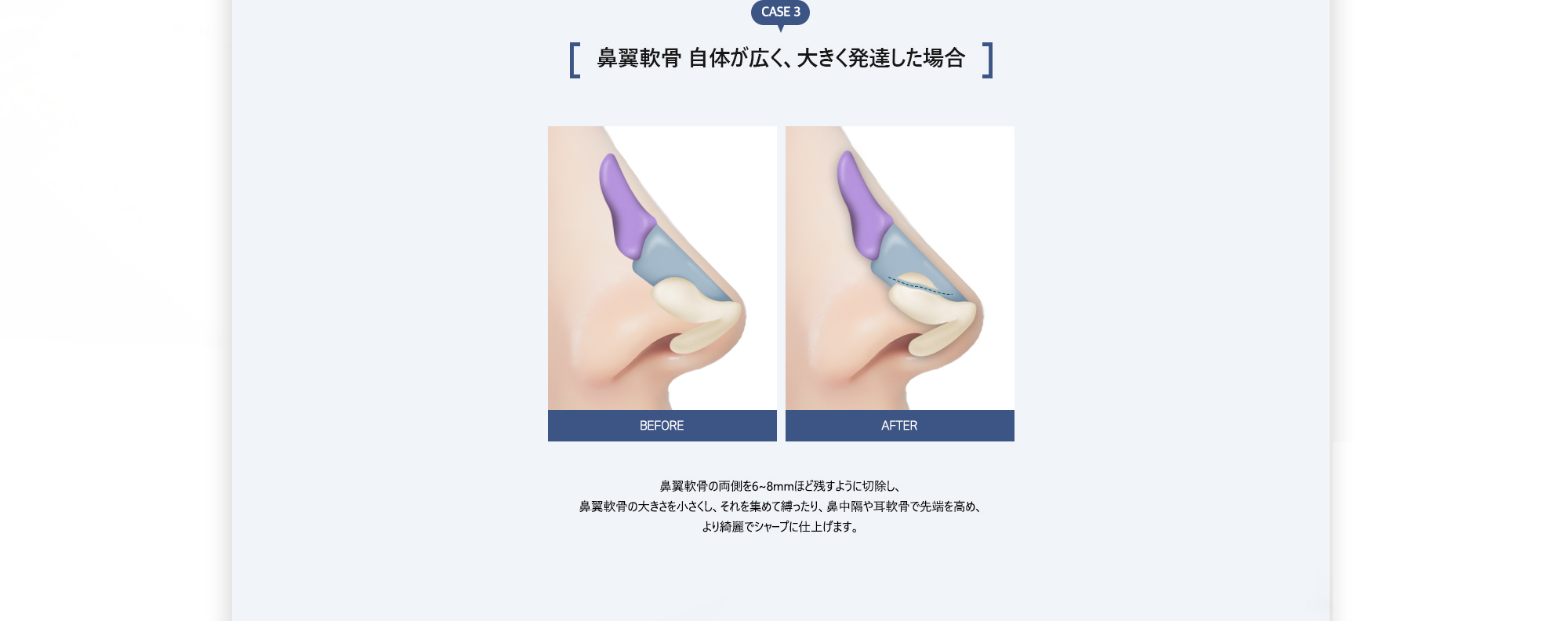 CASE 3. 鼻翼軟骨 自体が広く、大きく発達した場合 : 鼻翼軟骨の両側を6~8mmほど残すように切除し、鼻翼軟骨の大きさを小さくし、それを集めて縛ったり、鼻中隔や耳軟骨で先端を高め、より綺麗でシャープに仕上げます。