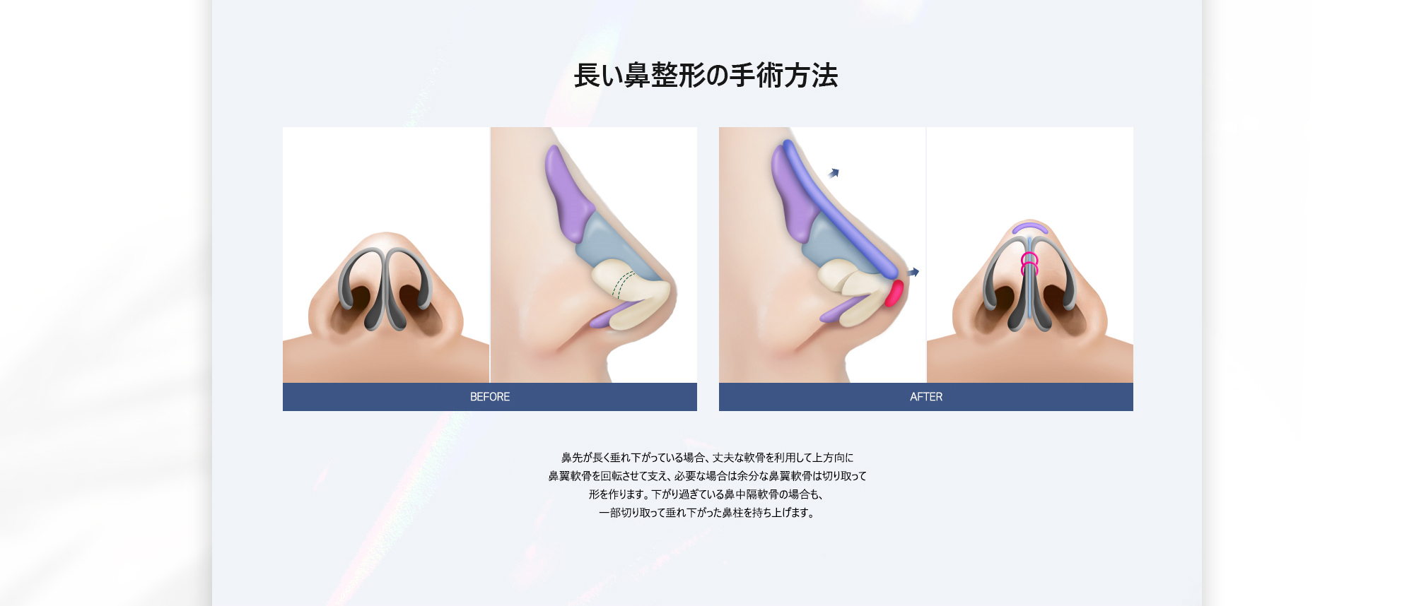 [長い鼻整形の手術方法] 鼻先が長く垂れ下がっている場合、大丈夫な軟骨を利用して上方向に鼻翼軟骨を回転させて支え、必要な場合は余分な鼻翼軟骨は切り取って形を作ります。下がり過ぎている鼻中隔軟骨の場合も、一部切り取って垂れ下がった鼻柱を持ち上げます。