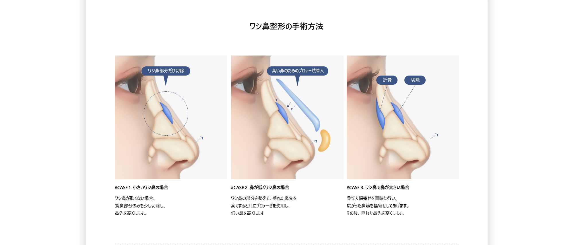 [ワシ鼻整形の手術方法] #CASE 1. 小さいワシ鼻の場合 : ワシ鼻が酷くない場合、鷲鼻部分のみを少し切除し、鼻先を高くします。/ #CASE 2. 鼻が低くワシ鼻の場合 : ワシ鼻の部分を整えて、垂れた鼻先を高くすると共にプロテーゼを使用し、低い鼻を高くします / #CASE 3. ワシ鼻で鼻が大きい場合 : 骨切り幅寄せを同時に行い、広がった鼻筋を幅寄せしてあげます。その後、垂れた鼻先を高くします。