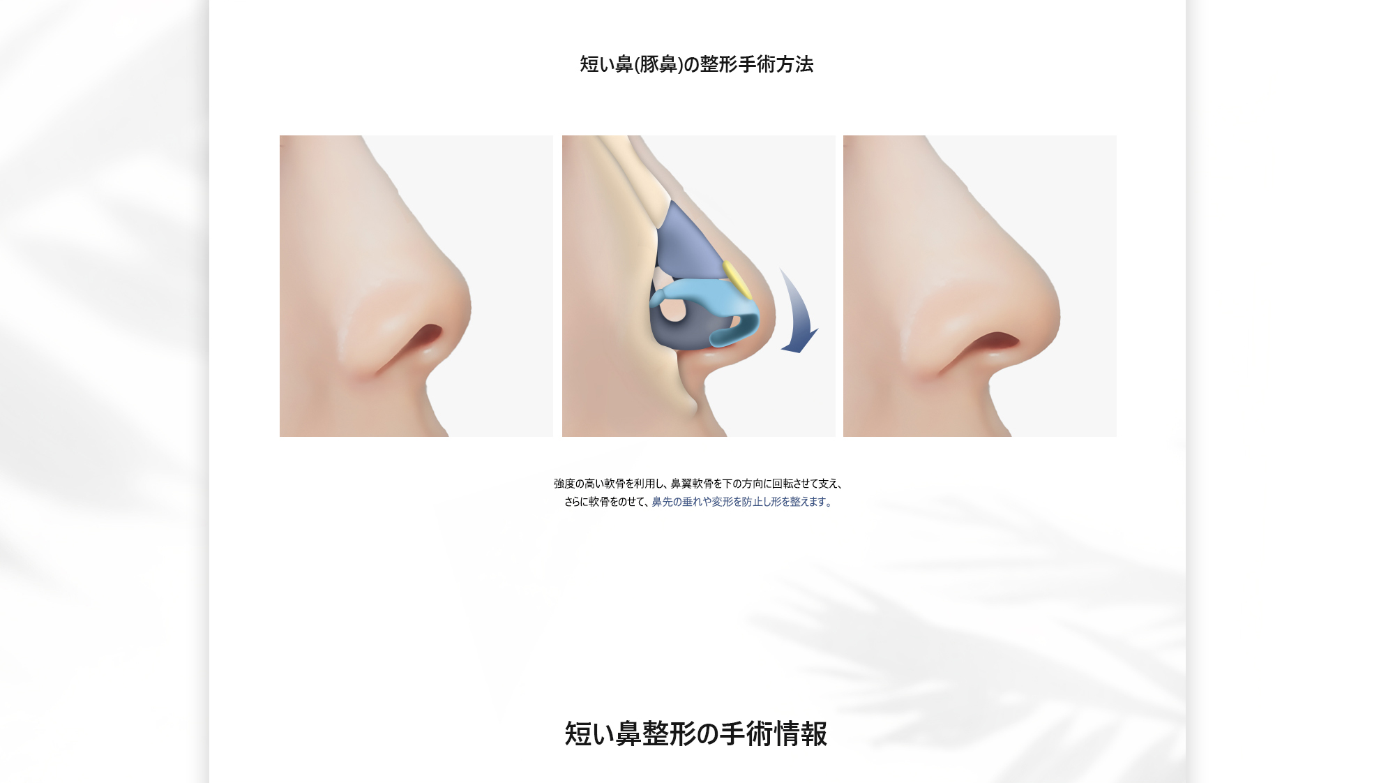 [短い鼻(豚鼻)の整形手術方法] 強度の高い軟骨を利用し、鼻翼軟骨を下の方向に回転させて支え、さらに軟骨をのせて、鼻先の垂れや変形を防止し形を整えます。