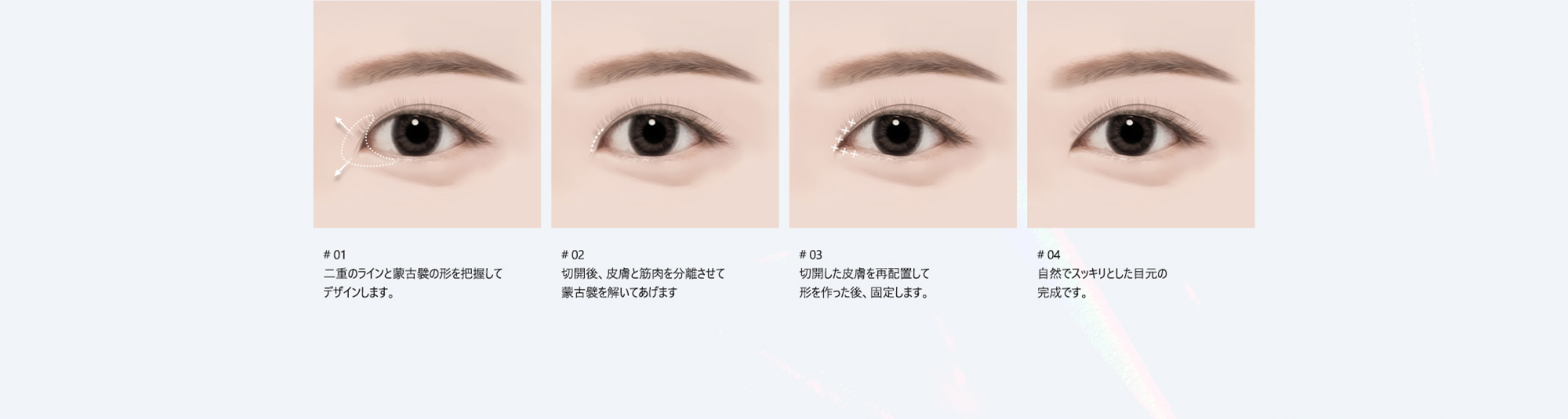 # 01 : 二重のラインと蒙古襞の形を把握してデザインします。  # 02 : 切開後、皮膚と筋肉を分離させて蒙古襞を解いてあげます  # 03 : 切開した皮膚を再配置して形を作った後、固定します。  # 04 : 自然でスッキリとした目元の完成です。  