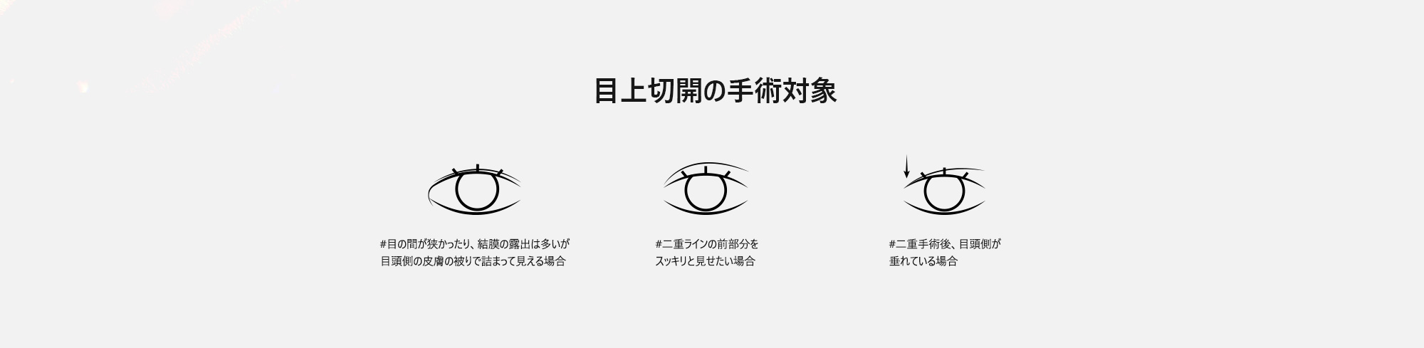 [目上切開の手術対象] #目の間が狭かったり、結膜の露出は多いが目頭側の皮膚の被りで詰まって見える場合 #二重ラインの前部分をスッキリと見せたい場合 #二重手術後、目頭側が垂れている場合