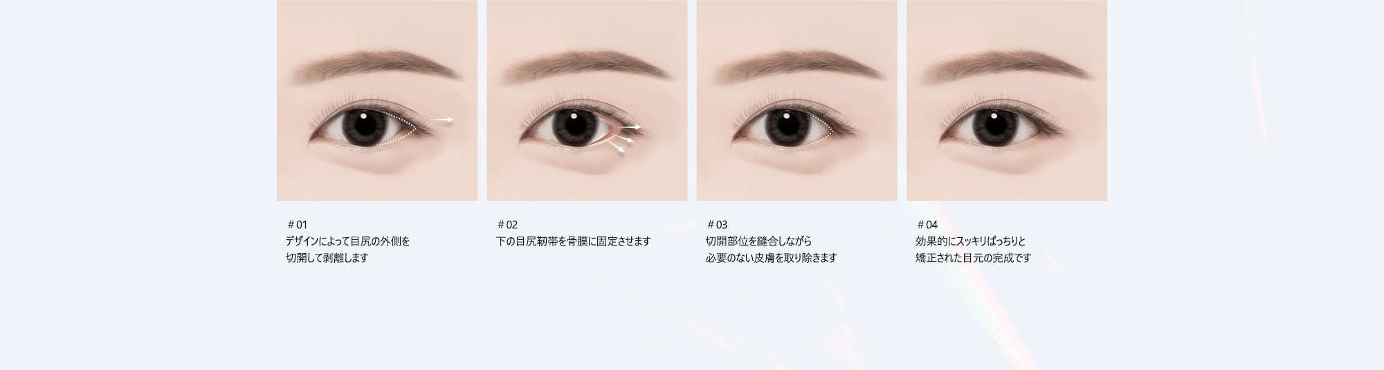 ＃01 : デザインによって目尻の外側を切開して剥離します  ＃02 : 下の目尻靭帯を骨膜に固定させます  ＃03 : 切開部位を縫合しながら必要のない皮膚を取り除きます  ＃04 : 効果的にスッキリぱっちりと矯正された目元の完成です  