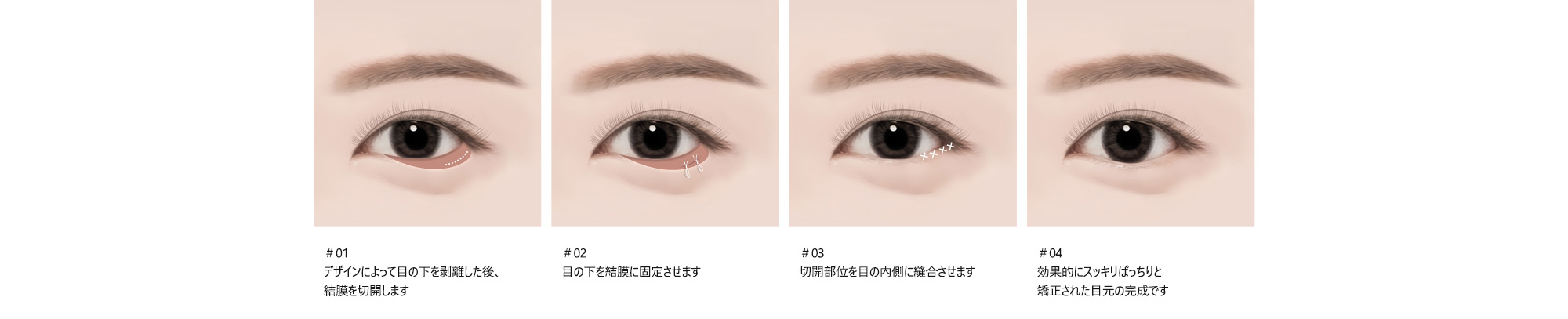 ＃01 : デザインによって目の下を剥離した後、結膜を切開します  ＃02 : 目の下を結膜に固定させます  ＃03 : 切開部位を目の内側に縫合させます  ＃04 : 効果的にスッキリぱっちりと矯正された目元の完成です